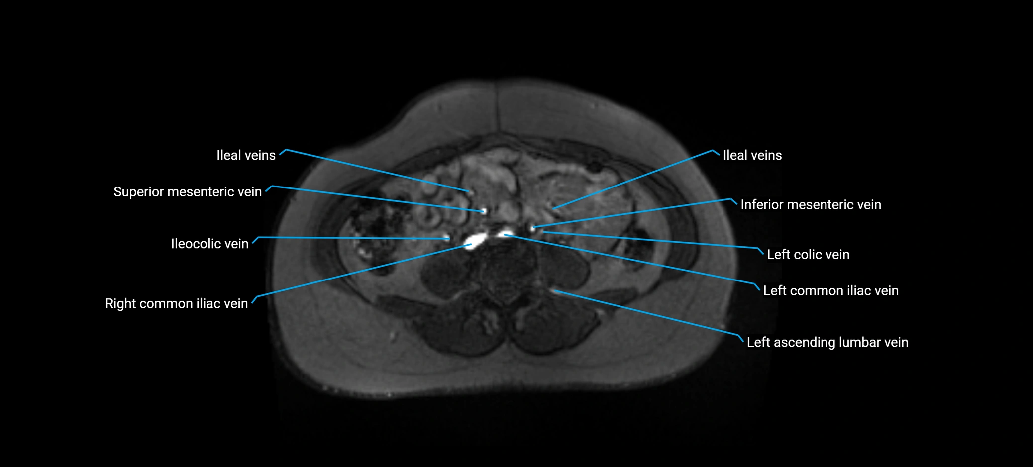 MRV abdomen pelvis & lower limb axial cross sectional anatomy labelled MRI image 111 (1).webp
